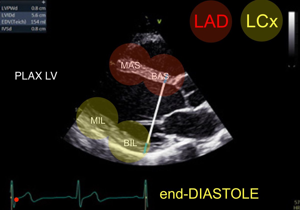 POCUSpeek's tweet image. 5/365 #firstecho #POCUS #VeXUS 
Left ventricular (LV) wall thickness and internal
∅ measures performed at end-diastole and end-systole 👇(PLAX)