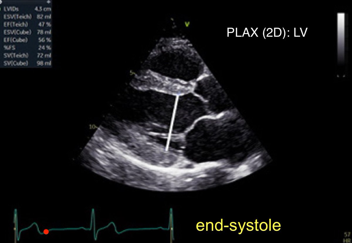 POCUSpeek's tweet image. 5/365 #firstecho #POCUS #VeXUS 
Left ventricular (LV) wall thickness and internal
∅ measures performed at end-diastole and end-systole 👇(PLAX)