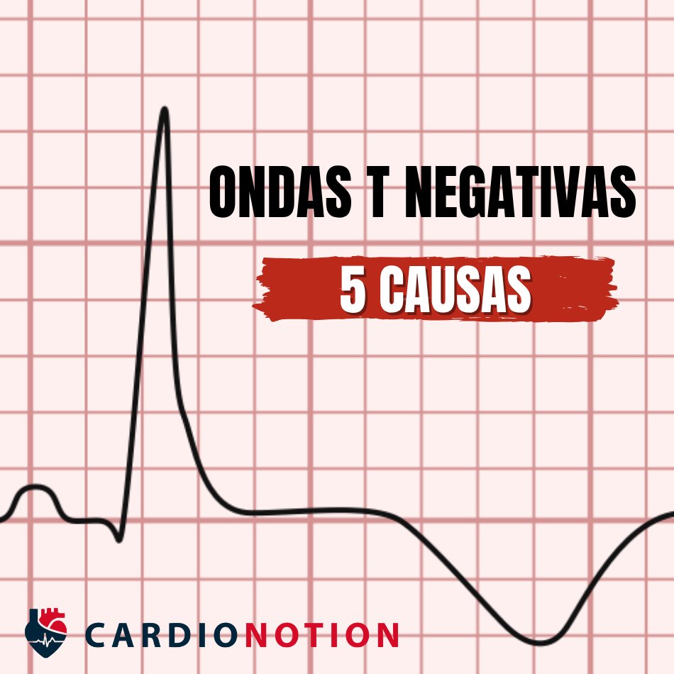 ¿Ondas T invertidas en el ECG? No las ignores‼️

Una T negativa marcada puede ser la pista clave para el diagnóstico 🚨

En este hilo te explico las 5 causas principales que todo médico debería conocer 🧵👇