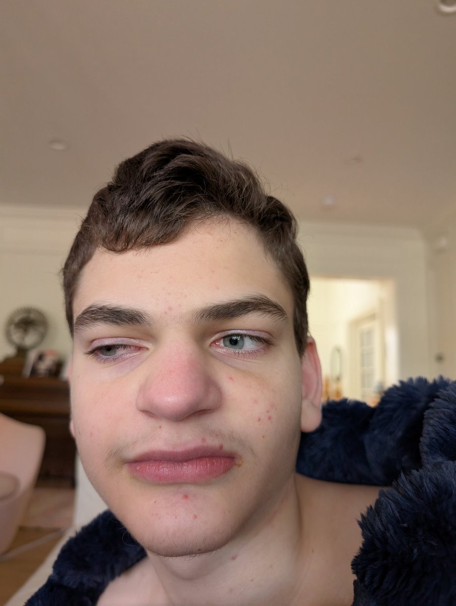 royalhansen's tweet image. Droopy eye after a stellate ganglion block. Next item on the #LongCovid list.