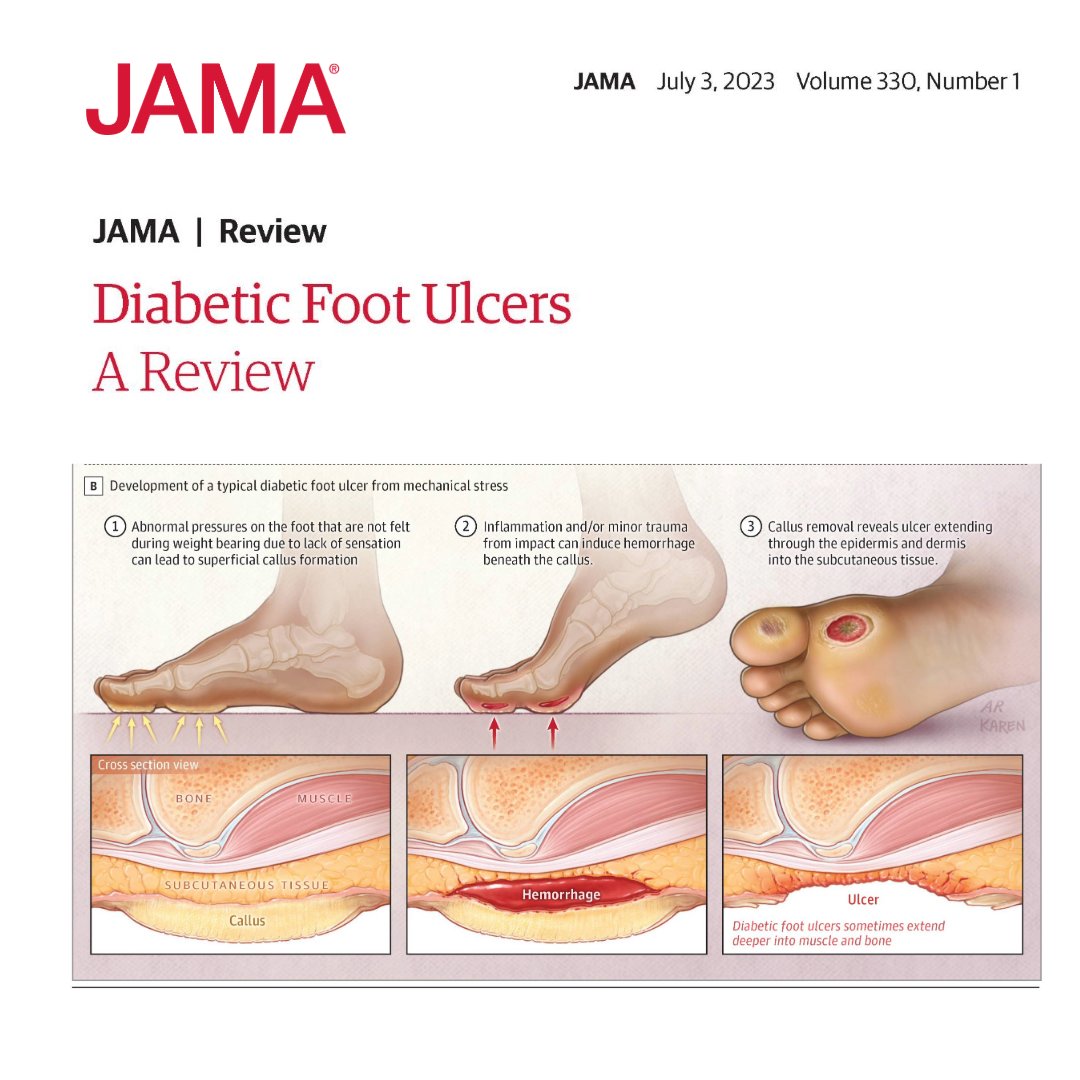 JAMA_current's tweet image. Approximately 18.6 million people worldwide are affected by a diabetic foot ulcer each year.
This Review summarizes the epidemiology, pathophysiology, diagnosis, treatment, and prevention of diabetic foot ulcers.
🔗 ja.ma/46nHnyR