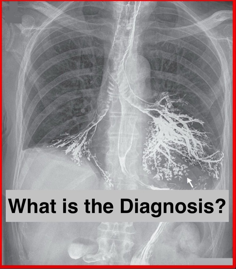 Paul_Wischmeyer's tweet image. An elderly man with unintentional weight loss & dysphagia following radiology procedure
What is the diagnosis?
#MedTwitter #MedX #MedEd #Radiology