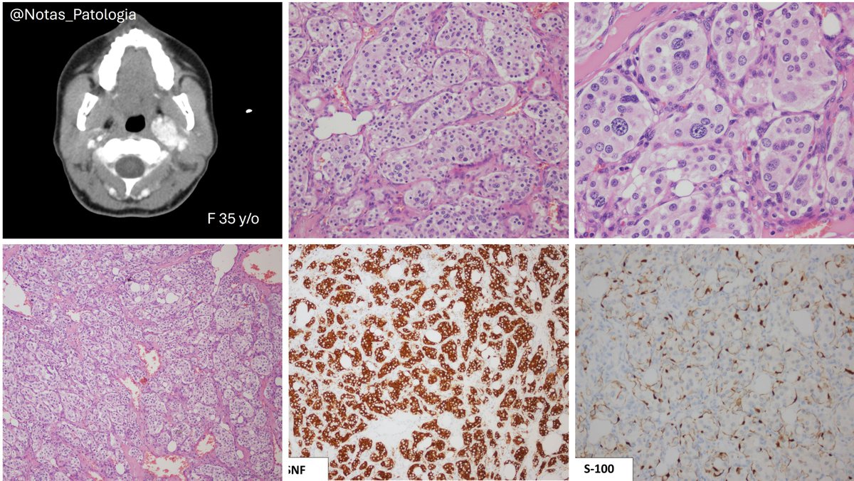 🔬 Head and Neck Paraganglioma
📌 Rare, non-epithelial neuroendocrine tumour derived from parasympathetic paraganglia.

🧾 Definition (WHO 5th ed.):
Paragangliomas of the head and neck are neuroendocrine neoplasms arising from paraganglionic cells of the autonomic nervous system,