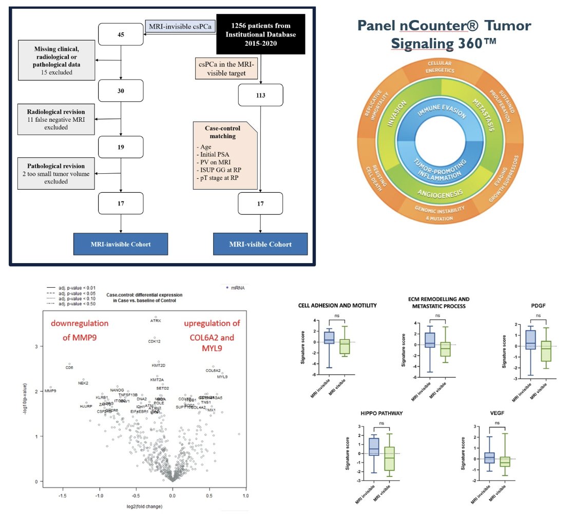 urotoday's tweet image. Histopathologic features and transcriptomic signatures do not solve the issue of magnetic resonance imaging-invisible #ProstateCancers: a matched-pair analysis. #ProstateCancer invisibility on mpMRI ≠ indolence! A matched-pair study found no histopathologic or transcriptomic…