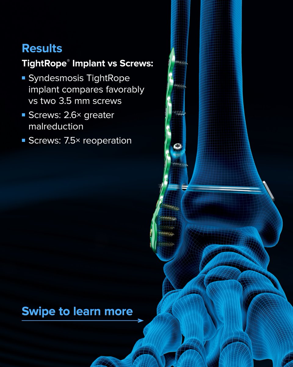 ArthrexMedEd's tweet image. This study compared the rate of malreduction after high fibular fractures associated with syndesmosis injury treated with open reduction and internal fixation using either 2 screws or the Knotless TightRope® implant. The study found that the TightRope device compared favorably to…