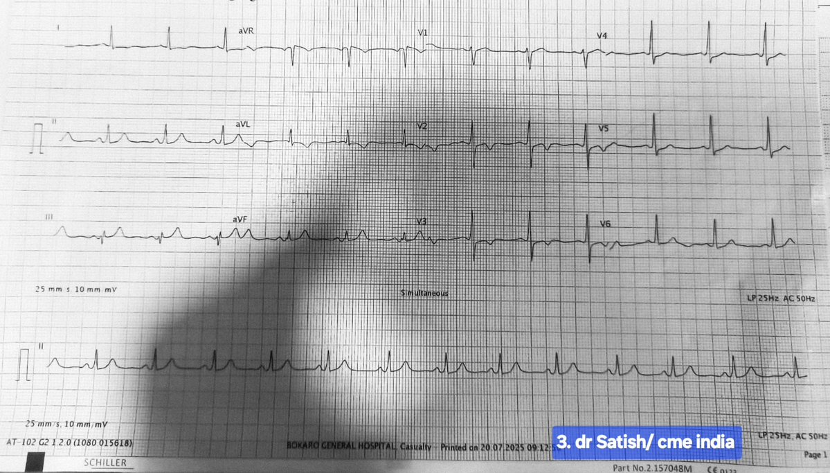 Case by  Dr Satish Kumar, Cardiologist, Bokaro: 
38ys Male, Non Smoker, No h/o DM or Hypertension.
Having intermittent heaviness in the chest with radiation to both the arms. Would occur at rest also.
 Symptoms occuring intermittently for 2 months,
ECG ( no 1 ) was done 2 months