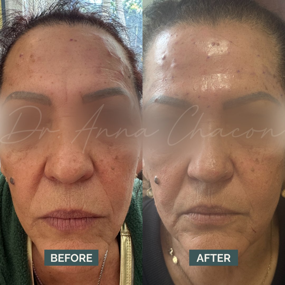 Before &amp; after Botox smoothing

Tip: Stay upright 4 hrs after treatment + avoid face rubbing for 24 hrs

📍 Coral Gables or 💻 Virtual 24/7 — book now! app.squarespacescheduling.com/schedule.php?o…

#botox