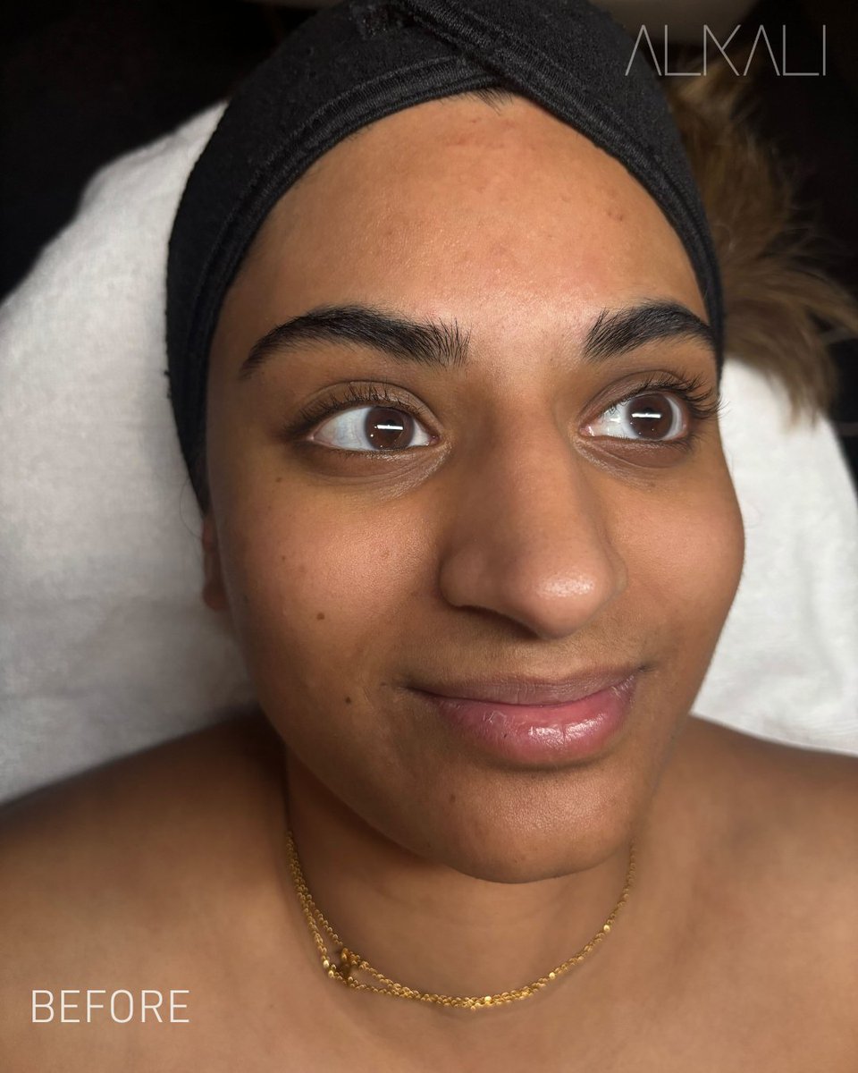 AlkaliHair's tweet image. Meet Samanta. Becca Sizemore performed #dermaplaning, a #DiamondGlowFacial for extra extractions of clogged pores, and a  lymphatic facial massage—plus gave her a #lashlift!😍

Want great skin? Book with Becca online or call 336-724-1453
bit.ly/439DStL

#alkaliwsnc