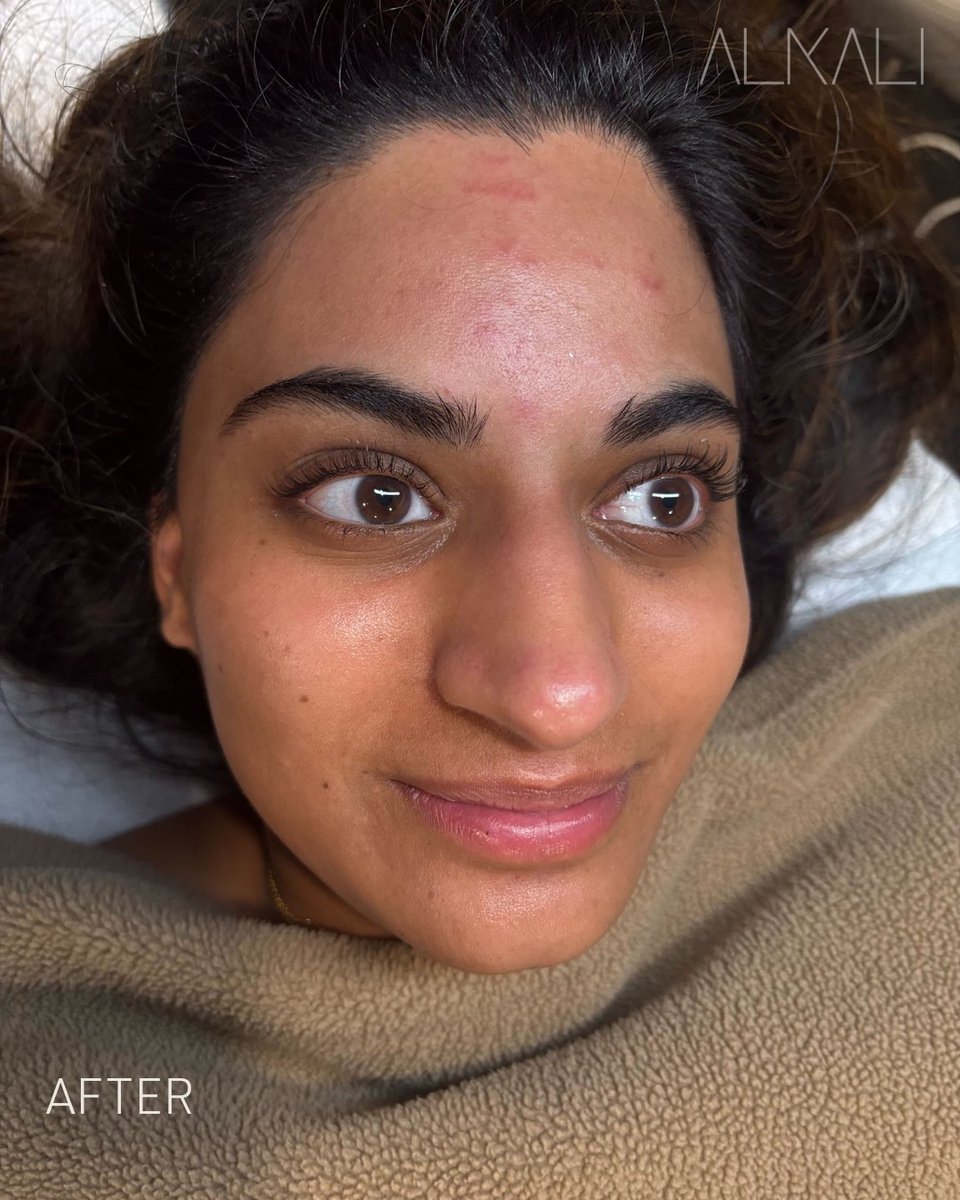 AlkaliHair's tweet image. Meet Samanta. Becca Sizemore performed #dermaplaning, a #DiamondGlowFacial for extra extractions of clogged pores, and a  lymphatic facial massage—plus gave her a #lashlift!😍

Want great skin? Book with Becca online or call 336-724-1453
bit.ly/439DStL

#alkaliwsnc