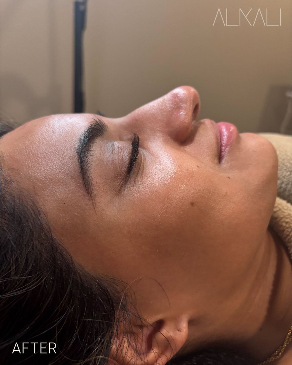 AlkaliHair's tweet image. Meet Samanta. Becca Sizemore performed #dermaplaning, a #DiamondGlowFacial for extra extractions of clogged pores, and a  lymphatic facial massage—plus gave her a #lashlift!😍

Want great skin? Book with Becca online or call 336-724-1453
bit.ly/439DStL

#alkaliwsnc