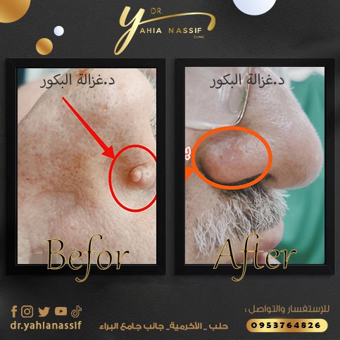 من حالات  إزالة الوحمة و إزالة التقرانات الزهمية 
نقدم حلاً آمناً وفعالاً ، تخلصي من العيوب دون ترك أي أثر.
احجزي موعدك اليوم لتجربة تعيد لك إشراقتك!
للتواصل والاستفسار:
+963 953 764 826

#إزالة_وحمة #تقرانات_زهمية #بشرة_صحية #تجميل #ثقة_بالنفس #عناية_بالبشرة #نتائج_مذهلة #جمال
