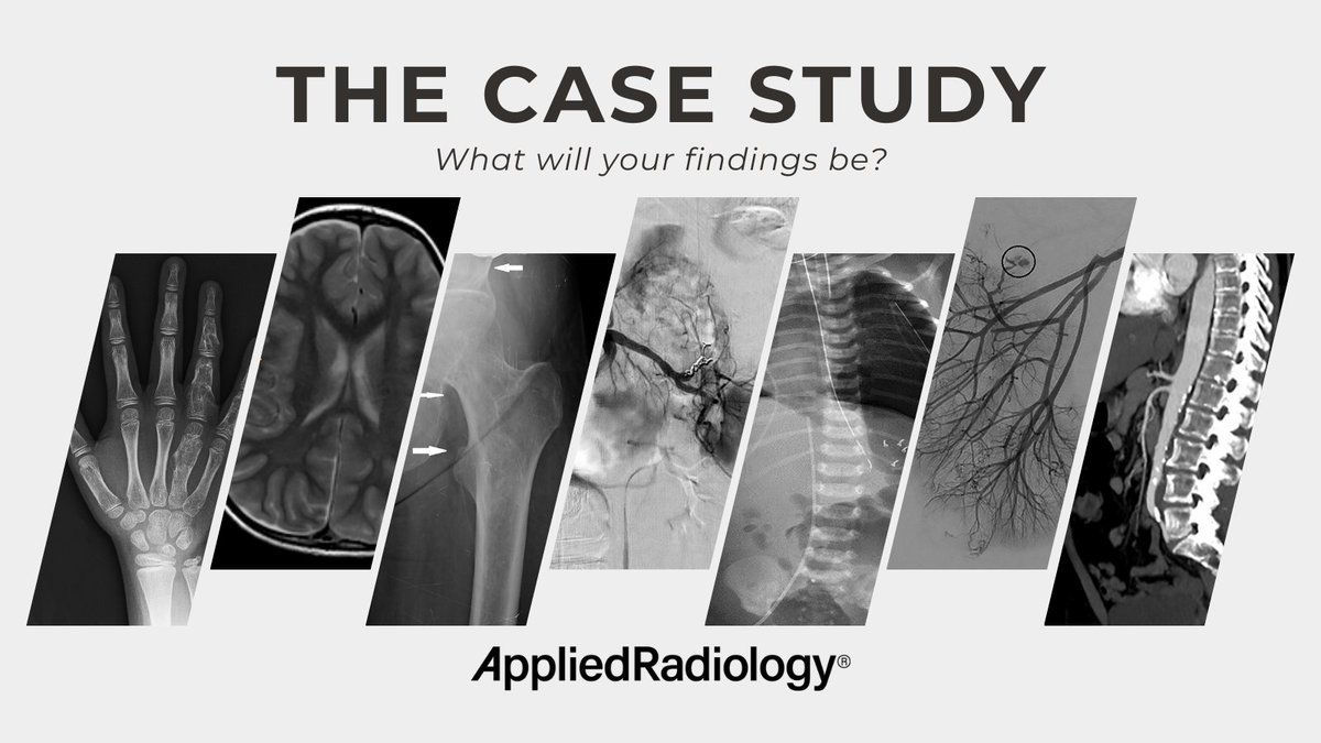 Applied_Rad's tweet image. 🩻 C O W time!

🔗 bit.ly/44JWDDJ

A newborn presented with ambiguous genitalia. Pelvic US demonstrated no Mullerian structures. Laboratory examination was essentially normal. Genetic testing showed a WT1 variant (a nonsense mutation [c.1999C&amp;gt;T])

#COW #RadEd #MedEd