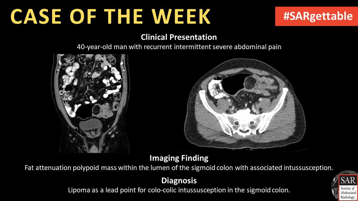 The answer to last week's #SARgettable Case of the Week, contributed by Kevin Chang is: Lipoma as a lead point for colo-colic intussusception in the sigmoid colon.

Thanks for playing!

#SAR #Radiology