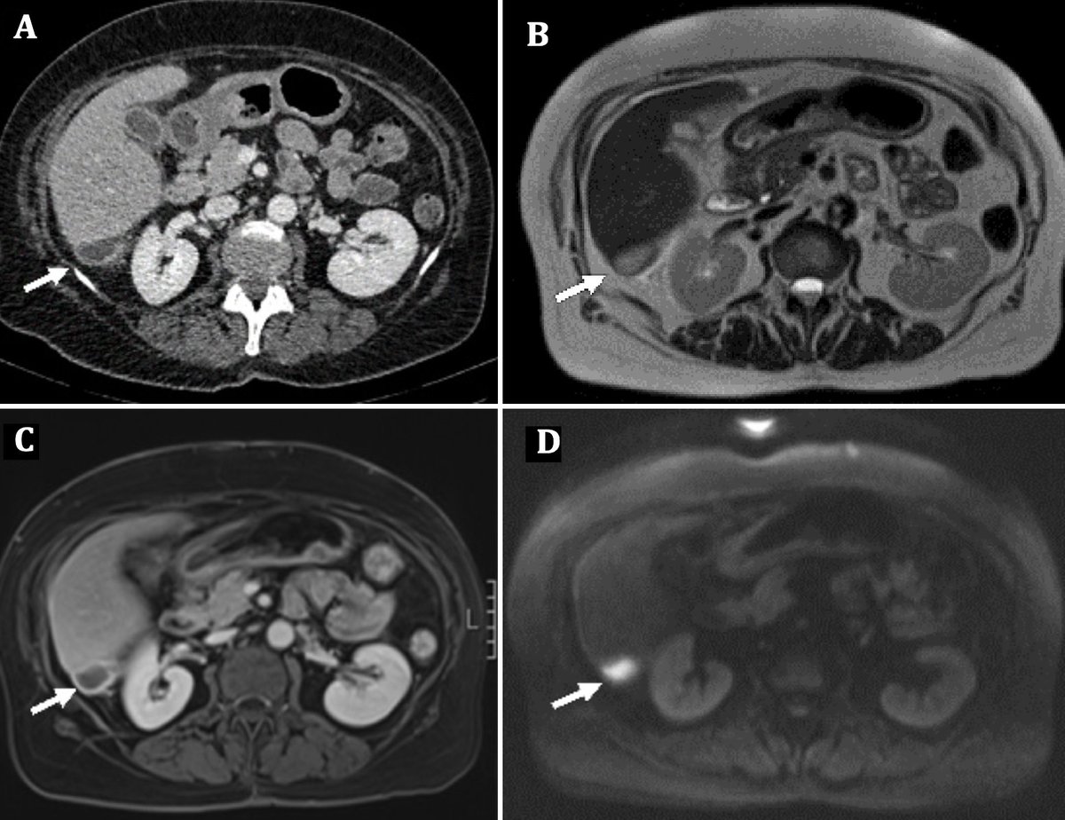 MedBlendPub's tweet image. 🦠 #CaseOfTheDay
🧠 Serophepatic Tuberculosis
📍62 HIV+ female presenting w/ fever.
CT: Subcapsular hypodense lesion in seg 6 + capsular thickening
MRI: T2 hyperintensity, thick peripheral rim on T1 post-contrast + diffusion restriction on DWI
Aspiration ➡️ TB
#radres #medX