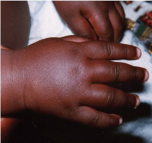 YourBabysDoctor's tweet image. You meet a 2 year old with this. What is the first thing that comes to your mind?