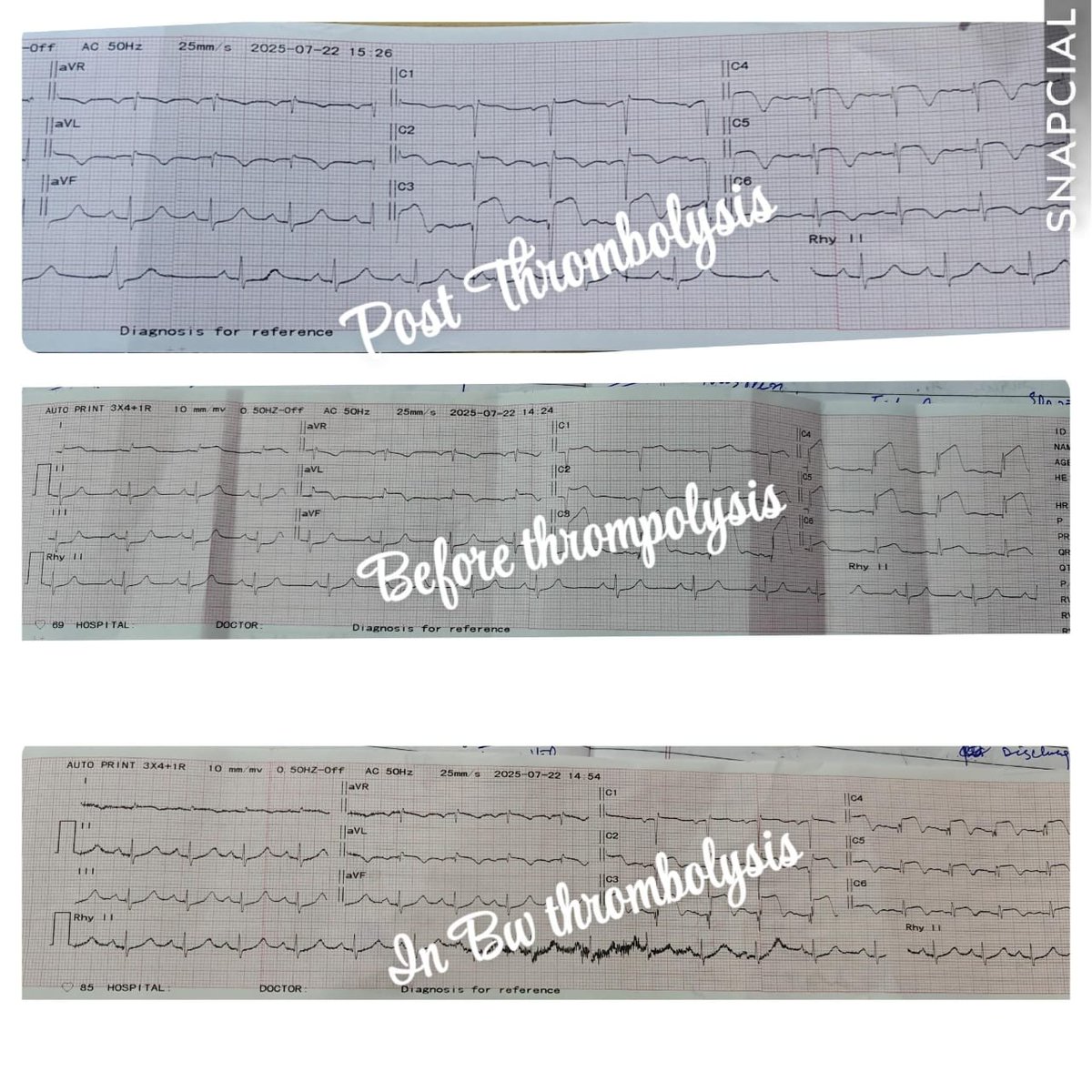 CMO Baramulla (@cmobaramulla) on Twitter photo *Precious lives being saved in peripheral health institutions*
Successful thrombolysis of a 40-year-old male with acute MI at CHC Uri using free Inj. Tenecteplase . Patient stabilized & referred to GMC Baramulla for advanced care.<a href="/SyedAbidShah/">Syed Abid Rasheed Shah</a> *Precious lives being saved in peripheral health institutions*
Successful thrombolysis of a 40-year-old male with acute MI at CHC Uri using free Inj. Tenecteplase . Patient stabilized & referred to GMC Baramulla for advanced care.<a href="/SyedAbidShah/">Syed Abid Rasheed Shah</a>