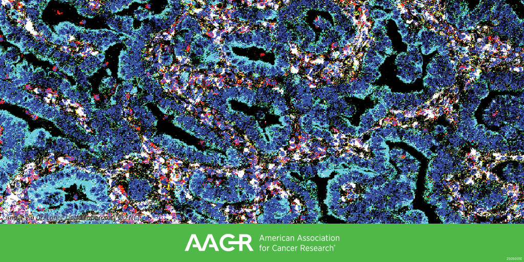 AACR's tweet image. William Freed-Pastor, Debora Barbosa Vendramini-Costa, and Julia Carnevale will discuss "Harnessing the Immune System to Treat Pancreatic Cancer" in a plenary at the AACR Conference on Pancreatic Cancer Research (Sept 28-Oct 1; Boston).
brnw.ch/21wUlfe
#AACRpan25