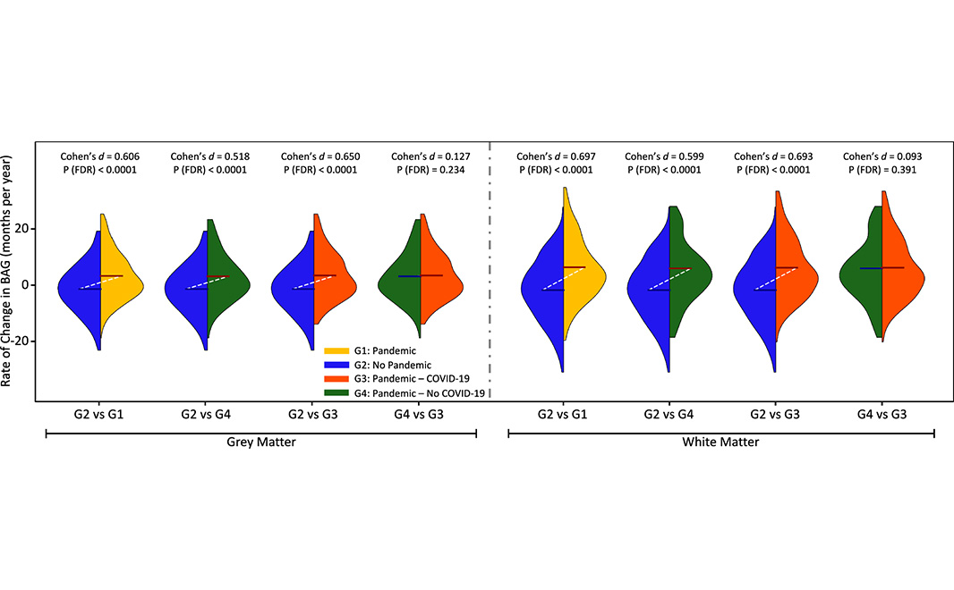 NaturePortfolio's tweet image. Rates of brain ageing accelerated during the COVID-19 pandemic, even among those who did not get infected with SARS-CoV-2, suggests a study of nearly 1,000 UK adults published in @NatureComms. go.nature.com/4lALDzP
