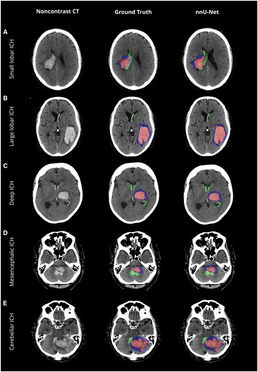 RSNA's tweet image. In a study published in Radiology Advances, Jawed Nawabi, MD, MHBA, MSc and colleagues aimed to evaluate an AI model (nnU-Net) for automated hemorrhage segmentation. bit.ly/4eU11Vv