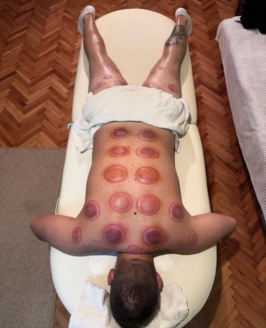 RebeccaTalbot02's tweet photo. Another successful detox session complete — and one more happy client! 🙌
Thank you for trusting me with your wellness journey.

📩 Book your appointment today!

#CuppingTherapy #CuppingMassage #DetoxNaturally #WellnessCare #DMToBook #HolisticHealing https://t.co/Z8DpZoTUh7