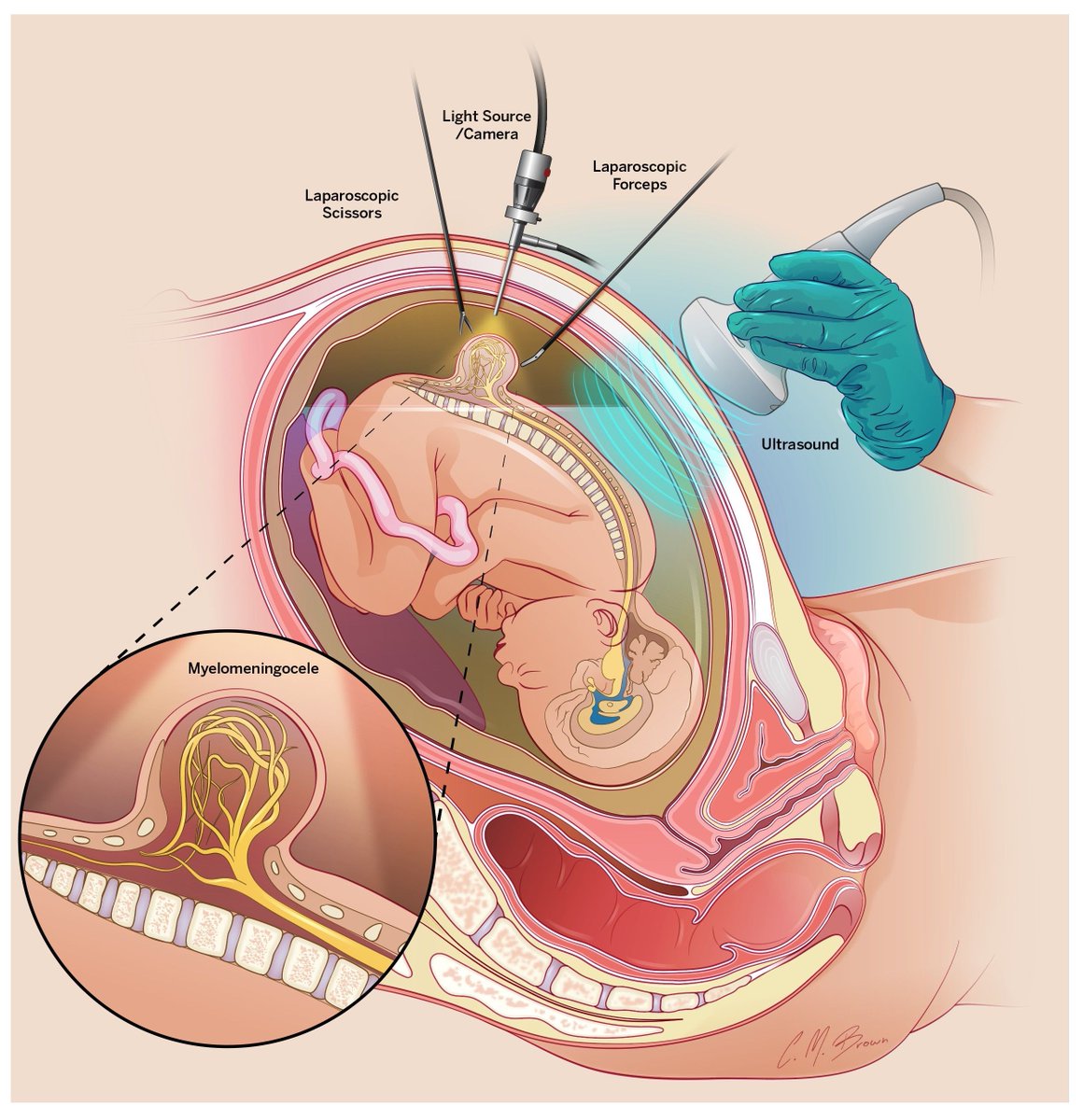 Neurosurgery_IU's tweet image. Kudos to Dr. Jason Chu, associate professor of clinical neurological surgery, for performing the state's first successful fetal repair of myelomeningocele—a severe form of spina bifida—at @RileyChildrens! The baby is being monitored and is expected to have better motor outcomes.