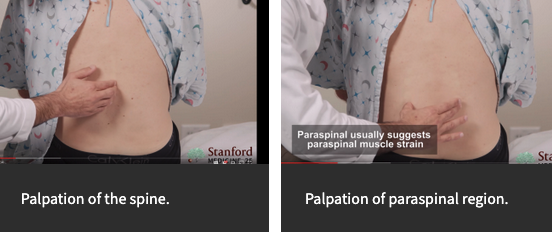 StanfordMed25's tweet image. When palpating the low back, we generally focus on two areas:
1. Center of spinal region – Pain here suggests pain from the from the vertebra
2. Just lateral to center or para-spinal regions – Pain here suggests muscle strain of the paraspinal muscles
stanford.io/2VAoTDP