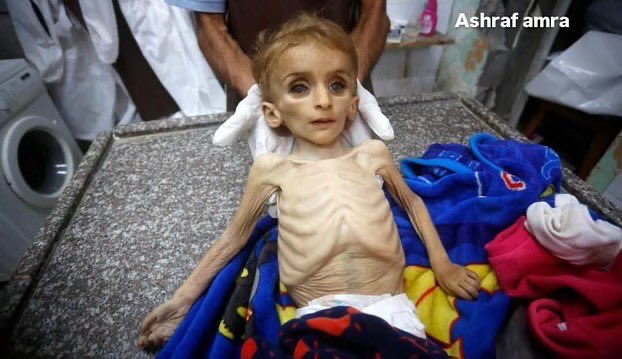 mahmoud60013's tweet image. Today, the death toll from hunger in Gaza has risen to 86 lives. 86 lives that could have been saved with food, compassion, and action. My heart breaks. For Tasneem, for being malnourished. For not having food. I cannot describe how helpless I feel. His voice echoes in my mind.…