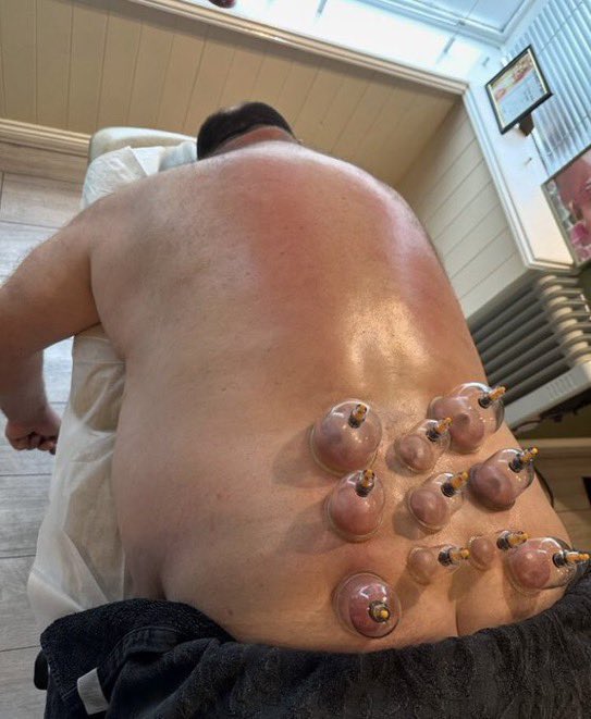 RebeccaTalbot02's tweet photo. Cupping therapy boosts circulation, eases muscle tension, and helps your body detox naturally. 😌
📩 DM now to book!

#CuppingTherapy #MuscleRecovery #NaturalDetox #MassageTherapy #RelaxAndRecover #WellnessCare #SportsMassage https://t.co/ZCdj8GKQP1