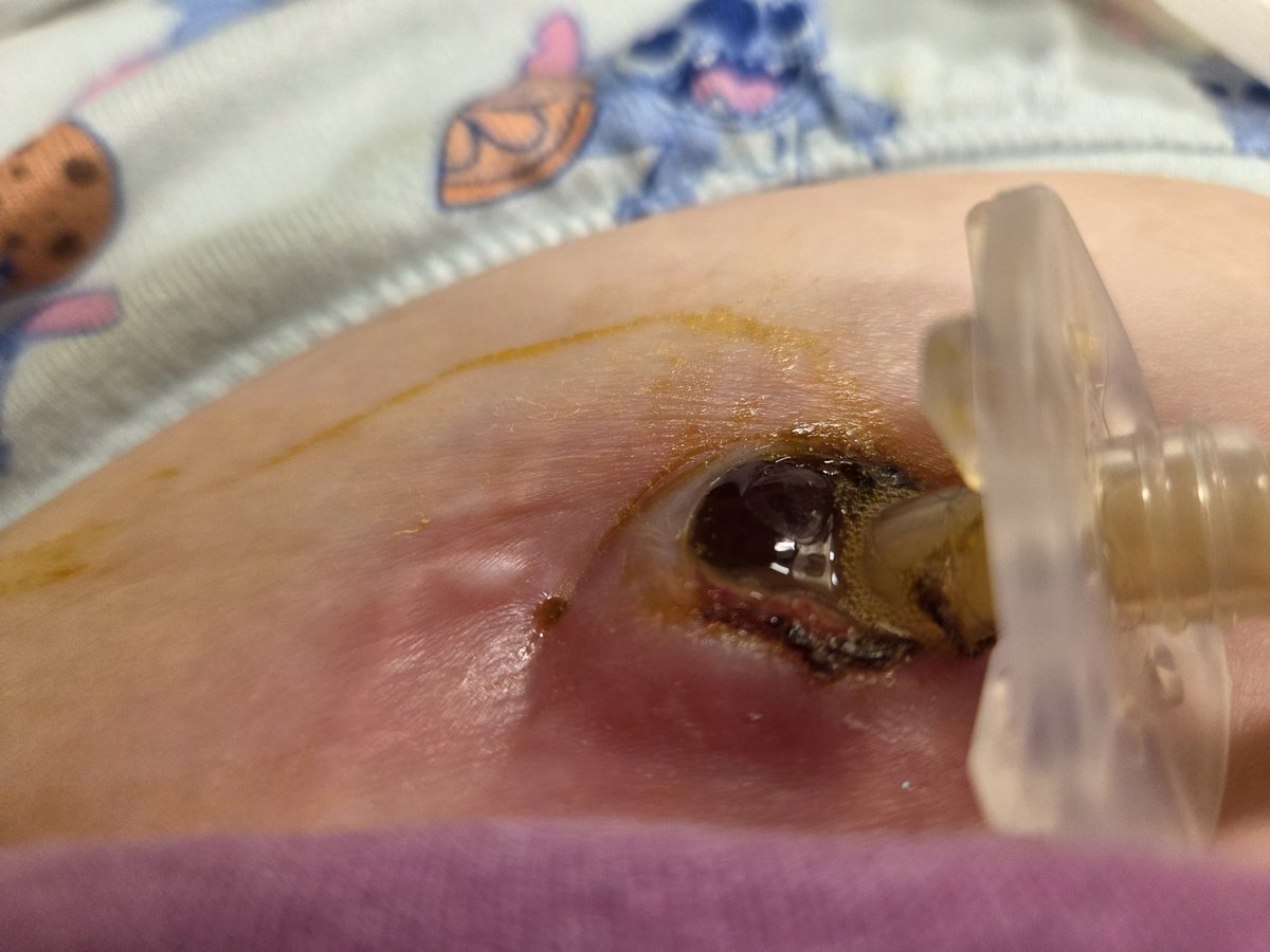 bamagirl_4_eva's tweet image. Still at the freestanding ER waiting to be transported to the hospital. No rooms available. Been here since around 7 last night. The pain from the tube being dislodged is so bad and is just getting worse. I'm also in pain from the fractured vertebrae and getting comfortable is…