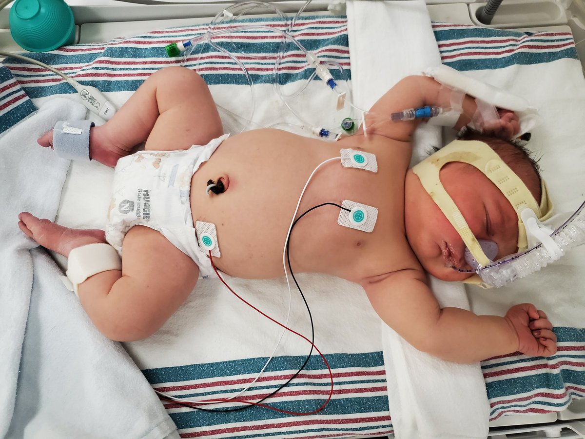 Dickmakas's tweet image. Baby boy is doing better. Respiration is lower since last night. Blood sugar and o2 still great. He's on the cpap but only to help alleviate the stress of breathing.
We ended up giving him the antibiotics and they started the culture last night. If there is nothing in the…