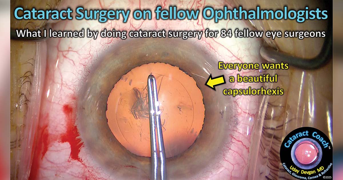 EuCornea (@eucornea) on Twitter photo What I have learned from performing cataract surgery on fellow ophthalmologists by Uday Devgan, MD via <a href="/Healio_OSN/">Ocular Surgery News</a>
healio.com/news/ophthalmo… What I have learned from performing cataract surgery on fellow ophthalmologists by Uday Devgan, MD via <a href="/Healio_OSN/">Ocular Surgery News</a>
healio.com/news/ophthalmo…