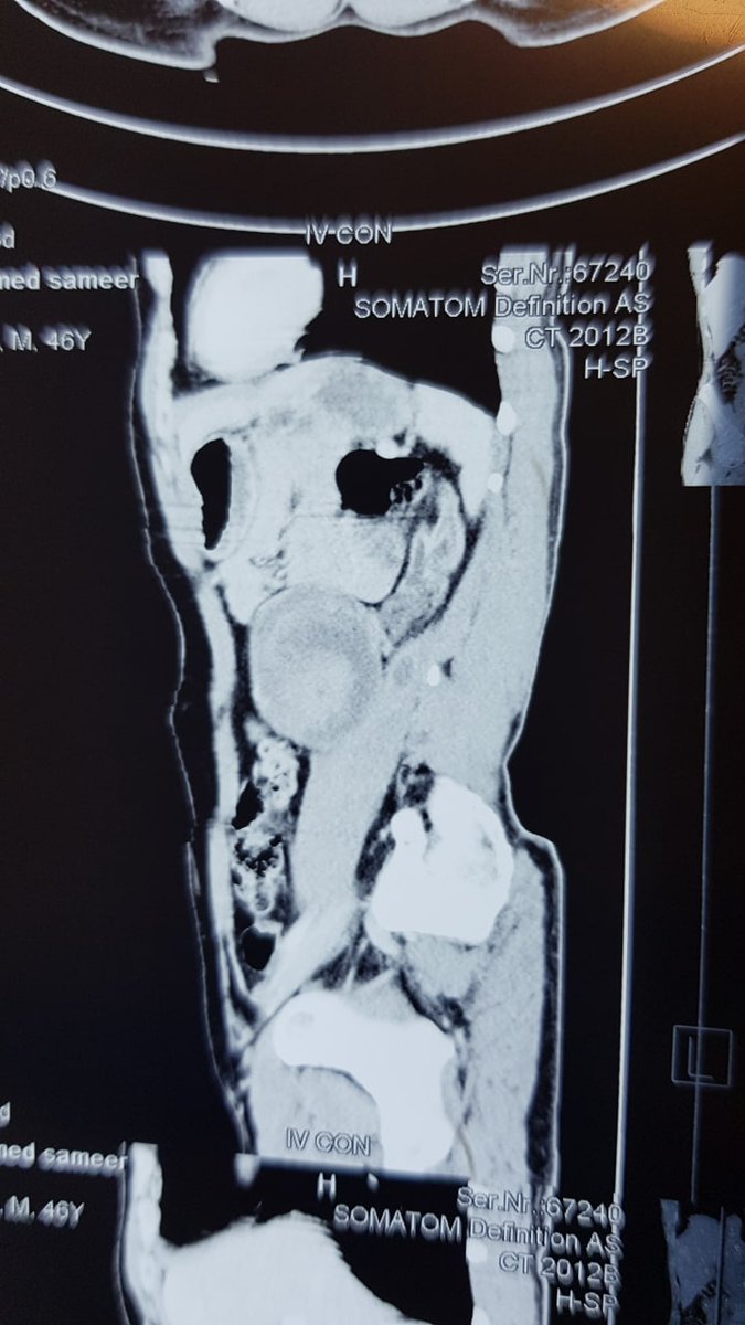 Guazoma
they did pelolithiotomy 15 years ago.