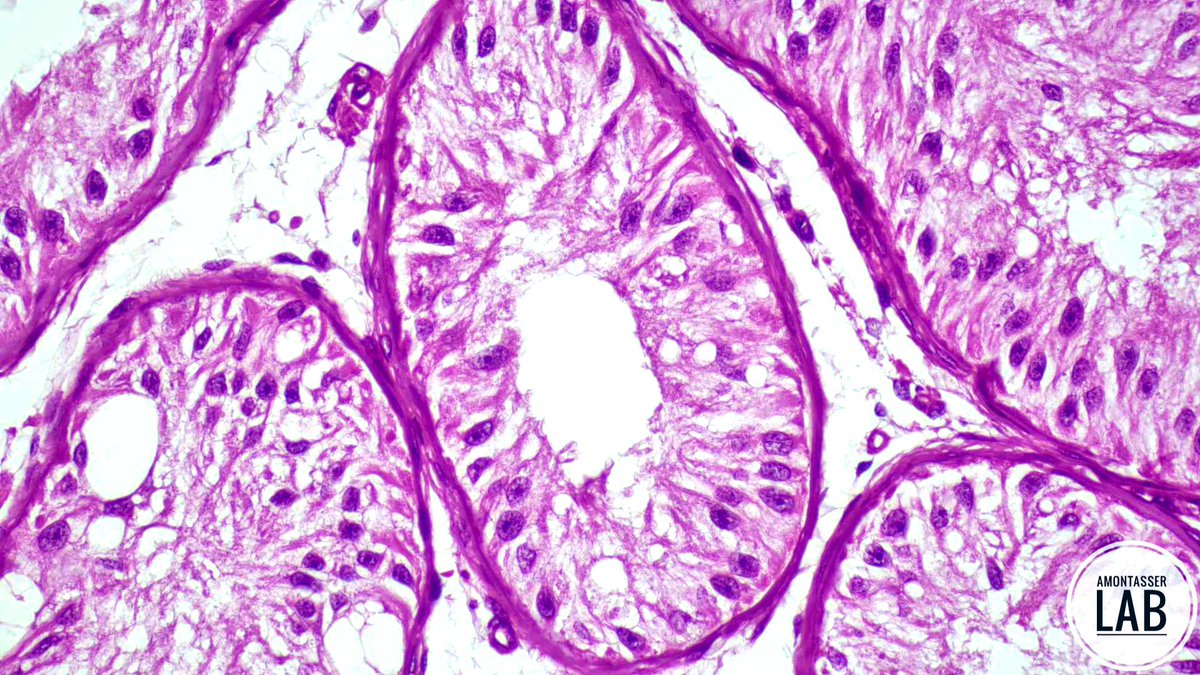 AMontasserMD's tweet image. Sertoli cell only 🕳️

#GUpath #Pathology #PathX