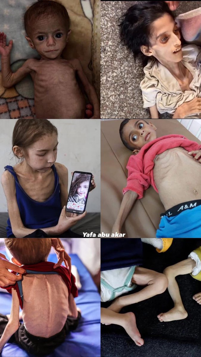 SQarman32315's tweet image. I feel like my heart will explode from what we see daily from children starving, how just how there is maybe Million child is without food and I see every one of them is suffering like this, his bones are 1000% tell the real story!
I am crying, my tears don’t stop, fuck the…