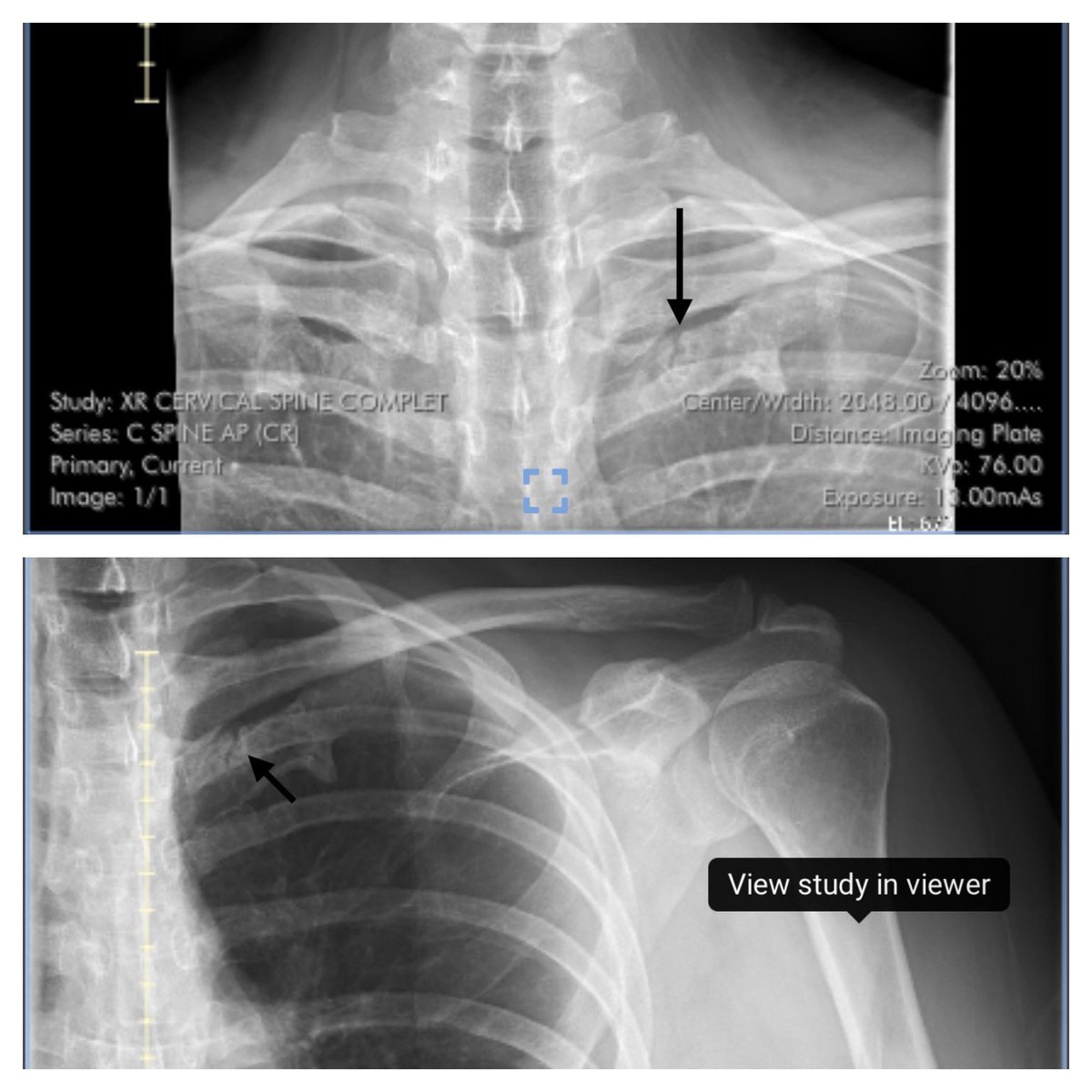 TankGirl1980's tweet photo. Hi pals ♥️ mama wants to know if anyone has any xray knowledge or xray friends to help mama. Techs ignored this. Mama haves left shoulder pain for a year &amp; sees something radiologist missed. #XRAY  #Radiology #Bones #ribs #brokenbone #imaging #doctor https://t.co/DjW3Ha0ZaR