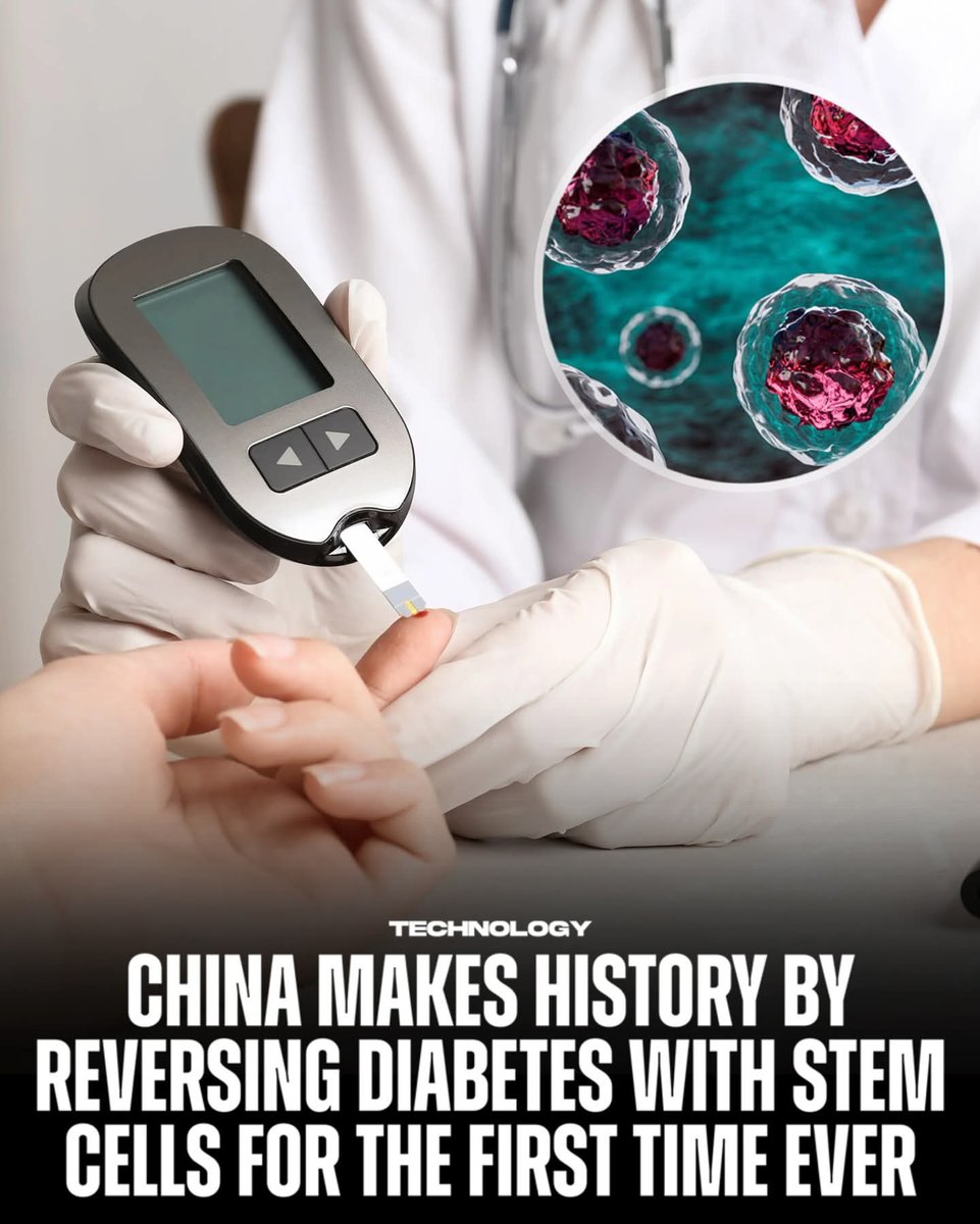 JaysonDC123's tweet image. For the first time ever, scientists in China have reversed type 1 diabetes in a 25-year-old woman using stem cell therapy.

Researchers reprogrammed her own fat cells into insulin-producing cells and implanted them into her abdomen. Remarkably, within just 75 days, she began…
