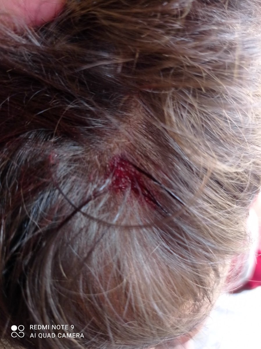 GazaIbn51701's tweet image. My little boy was injured in the head as a result of a stone falling on him and he needs an antibiotic and I cannot afford this medicine. I hope you can help me.
chuffed.org/project/137395…