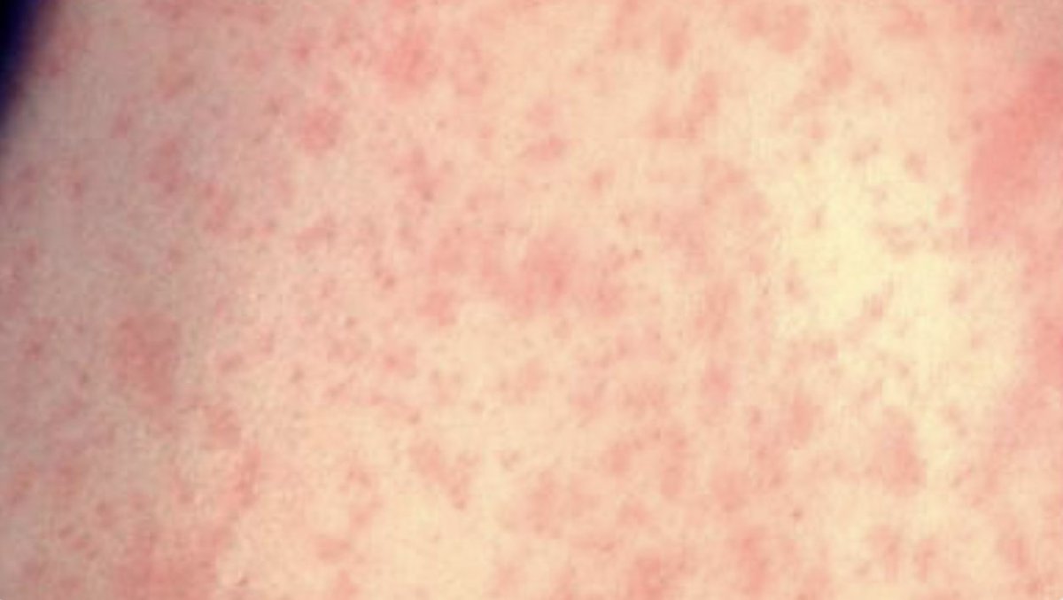 Canada sees new measles cases across 7 provinces and territories, with highest number in Alberta
spr.ly/6019fHxsf