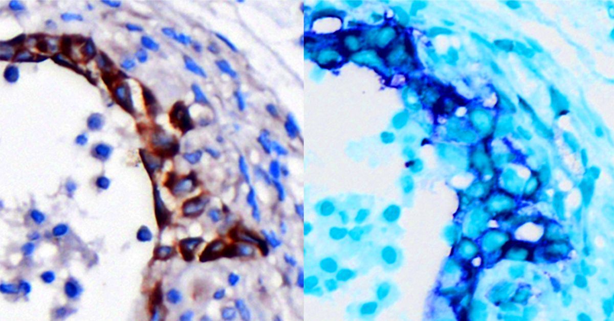 UCSDCancer's tweet image. 🔬 Researchers at @UCSDMedSchool have identified a gene signature that could serve as an early warning sign for pancreatic cancer
Understanding the protein STAT3 could help physicians identify patients with a higher risk of developing aggressive cancers, and work to develop…