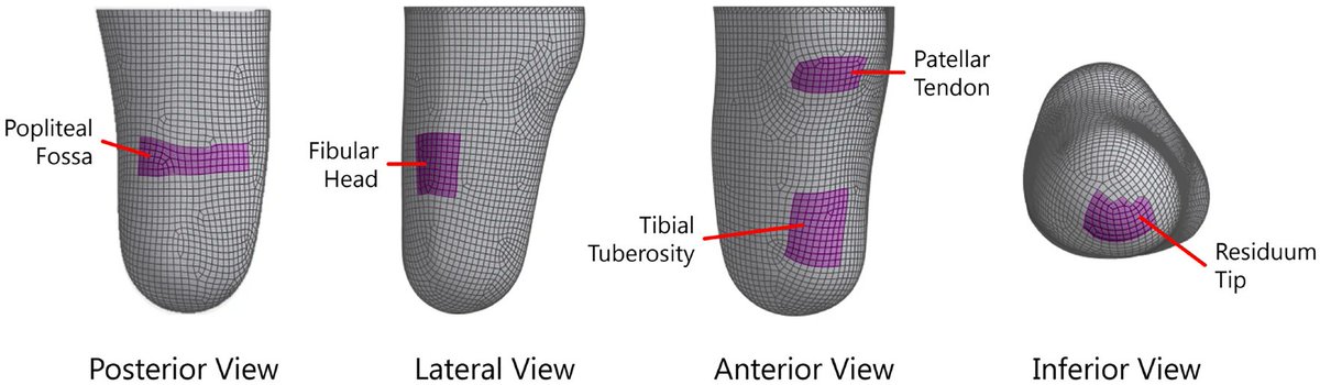 ABMEjournal's tweet image. Poorly fitting prosthetic sockets can cause pain and injury for lower-limb amputees, especially when the shape of the residual limb changes during movement.
To address this, researchers developed a computational model that accounts for how muscle contraction affects pressure…