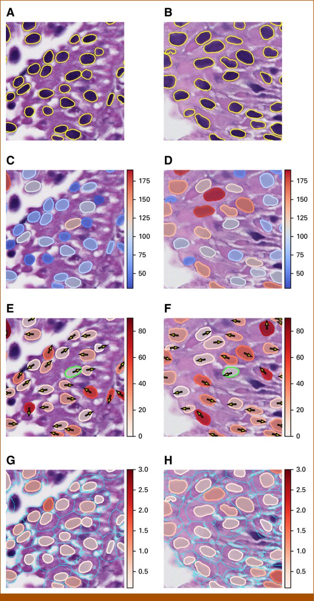 anantm's tweet image. 🚨 New paper in @JCOCCI_ASCO!
We show how interpretable ML on H&E slides can predict recurrence & survival in bladder cancer post-TURBT.
No black boxes—just biology-driven, explainable AI.
🔗 ascopubs.org/doi/10.1200/CC…
#DigitalPathology #BladderCancer #AIinMedicine