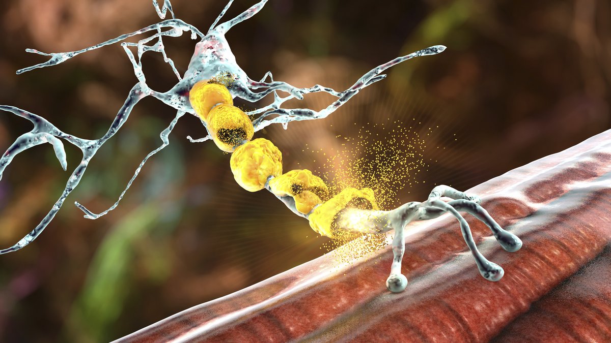 JWatch's tweet image. Dr. Robert Naismith comments on a study of stem cell transplantation vs. alemtuzumab and ocrelizumab for relapsing multiple sclerosis: jwat.ch/4maXuEJ