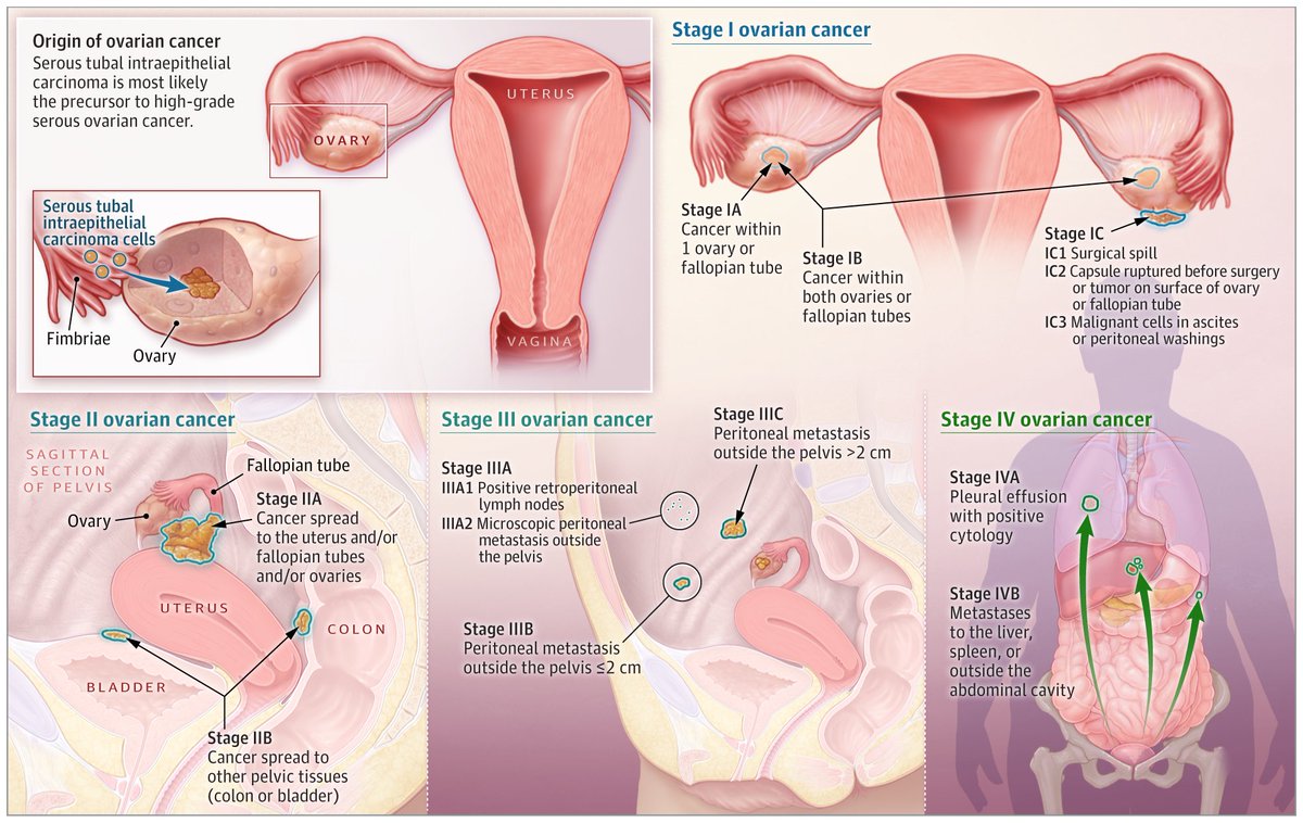【JAMA Ovarian Cancer A Review】
2025年7月の最新レビューです。
☞遺伝的因子は25%に関連し主にBRCA1/2。予防的両側卵管卵巣摘出術
☞診断時、95%が腹痛、膨満感、尿意切迫感や頻尿などの症状、かつ80%がIII-IV期
☞頻度は高悪性度漿液性、類内膜、明細胞、低悪性度漿液性、粘液性、癌肉腫の順