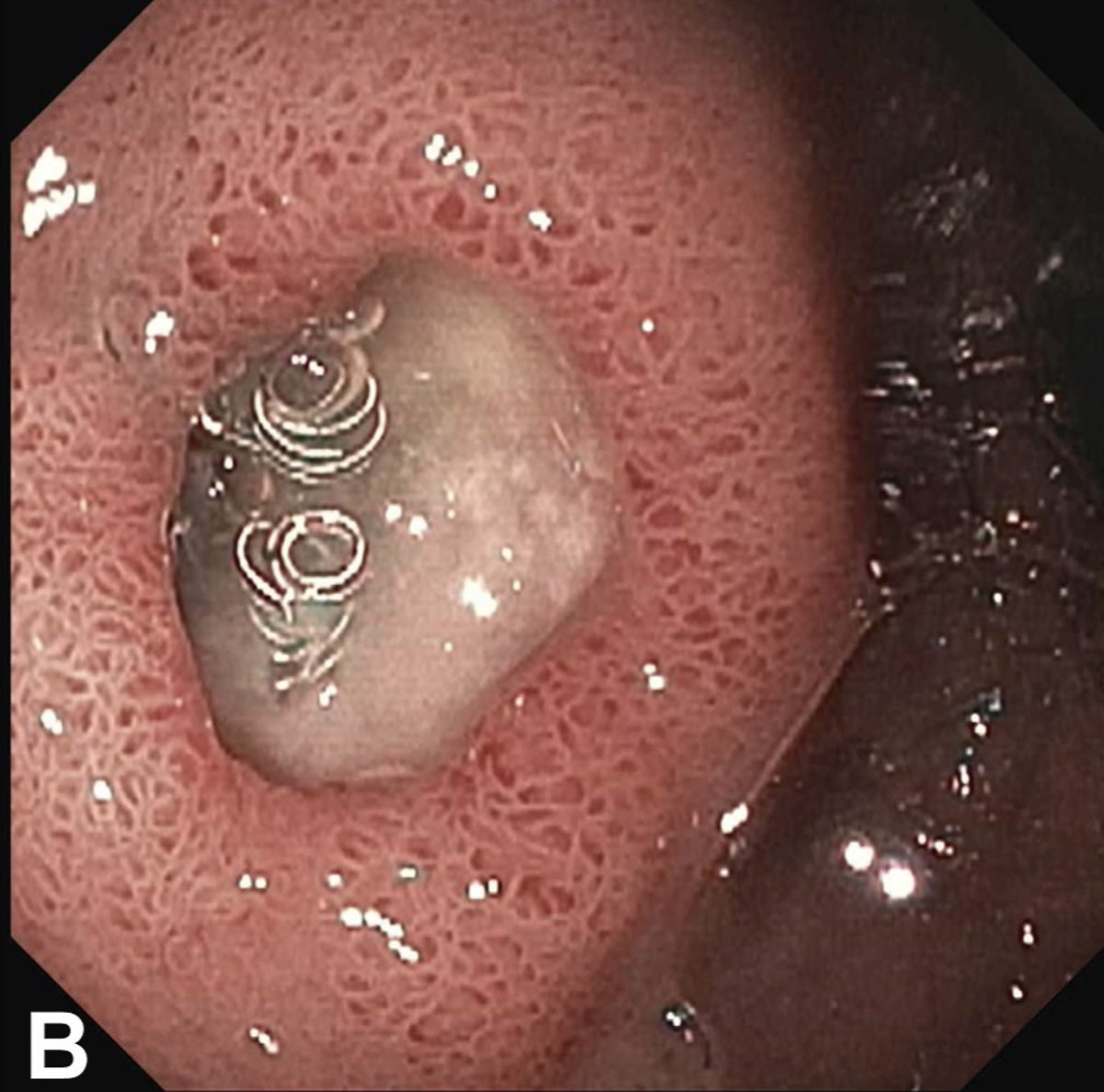drkeithsiau's tweet image. Endoscopic finding in the duodenum in a patient with GI bleeding. What’s the diagnosis?