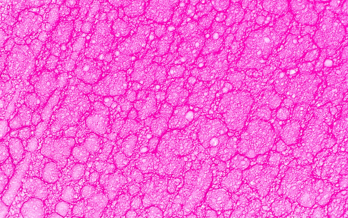 ziad_zaatari's tweet image. 🔬 Cool Bubbles in Small Renal Cyst ~ #Pathology #Histology #RenalPath #SciArt #BioArt #PathArt 📸🎨