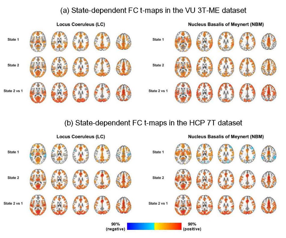 ImagingNeurosci's tweet image. New paper in Imaging Neuroscience by Haatef Pourmotabbed, Catie Chang et al.:
Multimodal state-dependent connectivity analysis of arousal and autonomic centers in the brainstem and basal forebrain
doi.org/10.1162/IMAG.a…