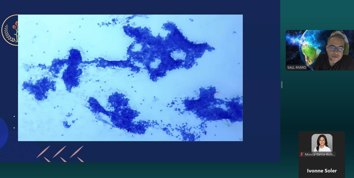 MonicaGarciaBuitrago (@monicagarciabu2) on Twitter photo Insightful lecture on #BreastCytology with Dr. Saul Rivero, diving into diagnostic challenges & cellular patterns 🔬💉<a href="/MerceJorda1/">Merce Jorda</a> <a href="/CarmenGomezMD/">Carmen Gomez-Fernandez, MD</a> <a href="/UMiamiPathology/">UMiami Pathology</a> <a href="/jalithsoler/">IVONNE JALITH SOLER CALVO</a> <a href="/martin_poveda82/">Martin Poveda</a>
#Patho #citologia #rose <a href="/IACytology/">International Academy Cytology</a> Insightful lecture on #BreastCytology with Dr. Saul Rivero, diving into diagnostic challenges & cellular patterns 🔬💉<a href="/MerceJorda1/">Merce Jorda</a> <a href="/CarmenGomezMD/">Carmen Gomez-Fernandez, MD</a> <a href="/UMiamiPathology/">UMiami Pathology</a> <a href="/jalithsoler/">IVONNE JALITH SOLER CALVO</a> <a href="/martin_poveda82/">Martin Poveda</a>
#Patho #citologia #rose <a href="/IACytology/">International Academy Cytology</a>