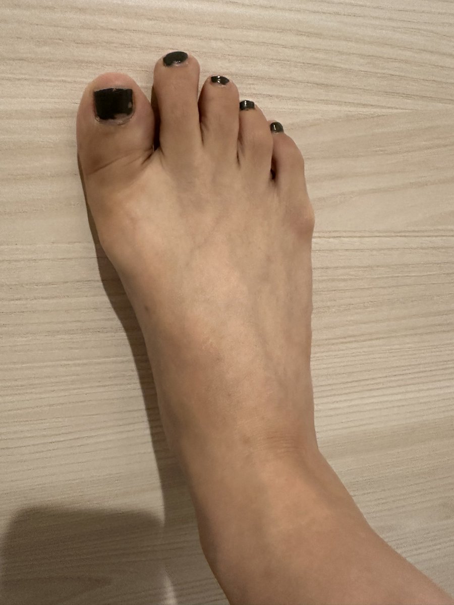 エスワンタイホウ
色素沈着経過観察21
2クール14日目
13日目は投稿忘れ

やっと終わった🥹
辛かった…

髪の毛ストレートだったけどチリチリの毛が増えた…🥹
#抗がん剤
#エスワンタイホウ　#色素沈着
#乳がん　#ルミナールb