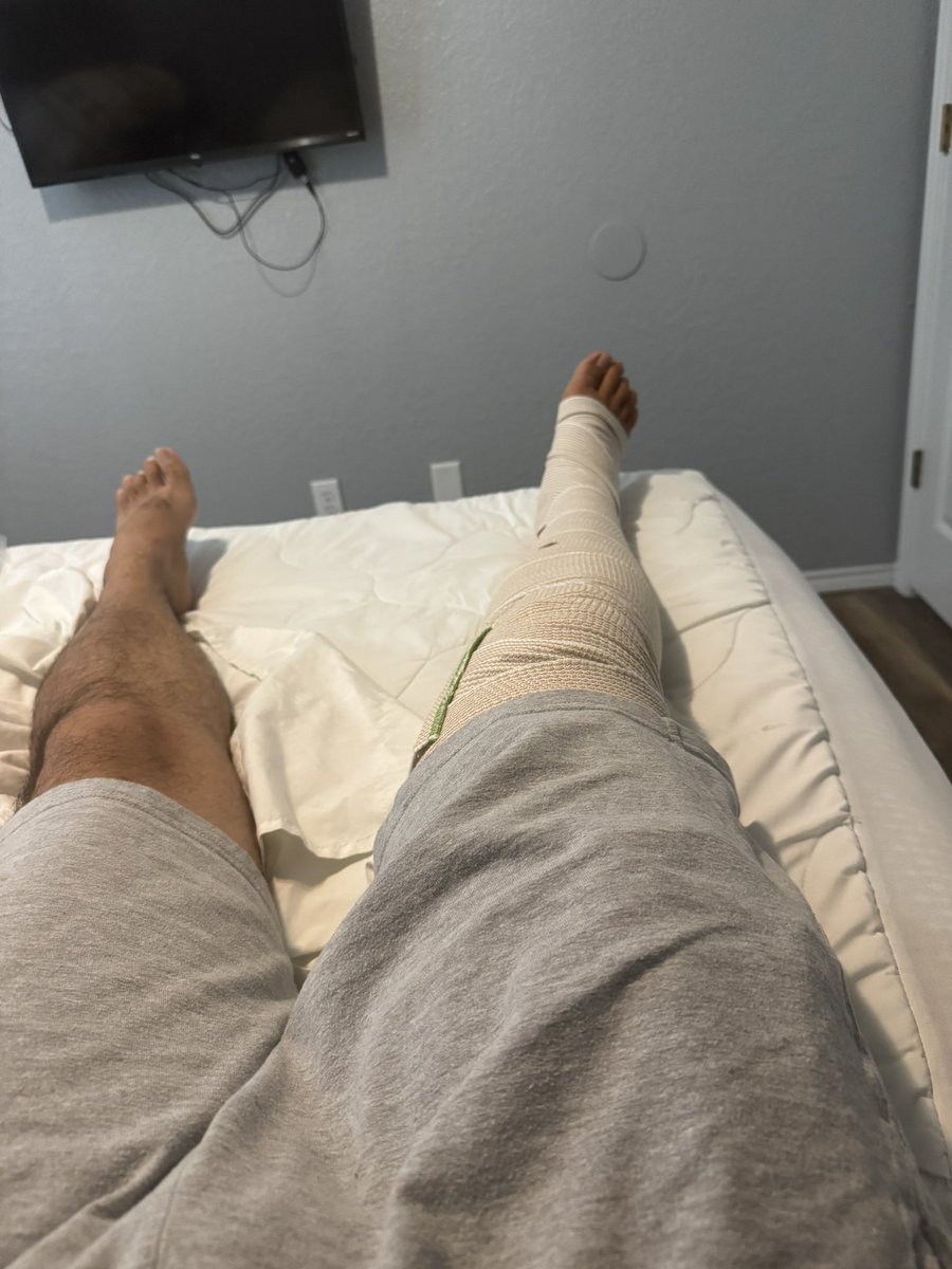 rockets4all2's tweet image. My left hand had 3 failed Iv’s, 1 good one during my surgery on my right leg today. When I got home I accidentally cut it open with a knife when cooking. I still got some code out today. No executes.