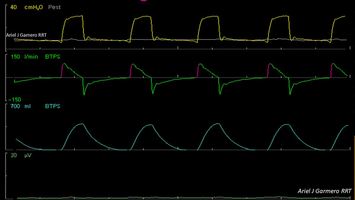 Ariel J Garnero (@arielg_rrt) on Twitter photo Post #1 of 2: What is your interpretation? There is a NAVA catheter monitoring Eadi. <a href="/DrMiguelIbarra1/">Dr. Miguel Ibarra-Estrada</a> <a href="/emireles_c/">Eduardo Mireles-Cabodevila</a> <a href="/CCF_PCCM/">CCF Pulmonary and Critical Care Fellows</a> <a href="/RespiratorySCCM/">SCCM Respiratory Care Section</a> <a href="/critconcepts/">Critical Concepts</a> <a href="/IM_Crit_/">IMCrit</a> <a href="/DrSateeshPCCM/">Sateesh chandra</a> <a href="/MegriMohammed/">Mohammed Megri. MD</a> <a href="/OfVentilation/">Society of Mechanical Ventilation</a> <a href="/Vent_Busters/">VentBusters</a> <a href="/SaudiRTs/">Saudi Respiratory</a> Post #1 of 2: What is your interpretation? There is a NAVA catheter monitoring Eadi. <a href="/DrMiguelIbarra1/">Dr. Miguel Ibarra-Estrada</a> <a href="/emireles_c/">Eduardo Mireles-Cabodevila</a> <a href="/CCF_PCCM/">CCF Pulmonary and Critical Care Fellows</a> <a href="/RespiratorySCCM/">SCCM Respiratory Care Section</a> <a href="/critconcepts/">Critical Concepts</a> <a href="/IM_Crit_/">IMCrit</a> <a href="/DrSateeshPCCM/">Sateesh chandra</a> <a href="/MegriMohammed/">Mohammed Megri. MD</a> <a href="/OfVentilation/">Society of Mechanical Ventilation</a> <a href="/Vent_Busters/">VentBusters</a> <a href="/SaudiRTs/">Saudi Respiratory</a>